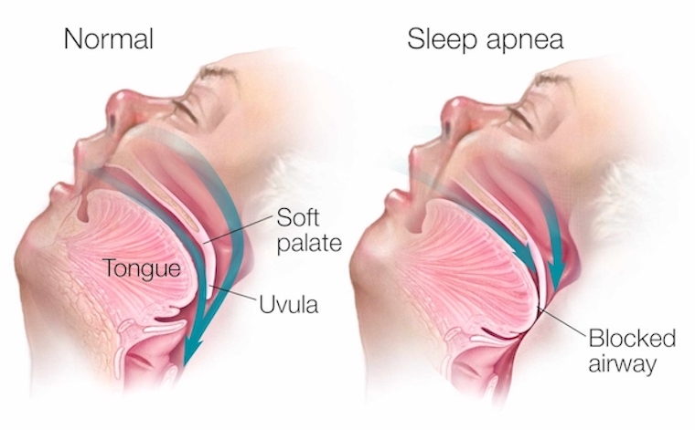 Image showing normal anatomy of airway versus sleep apnea anatomy of airway