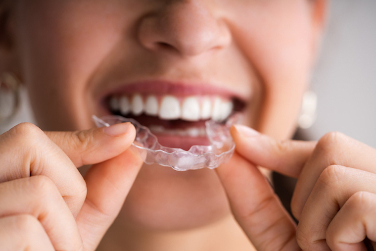 Woman putting in clear orthodontic aligners.